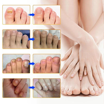 96PCS Toenail Antiseptic Patch Long Lasting Breathable Fungal Nail Patches