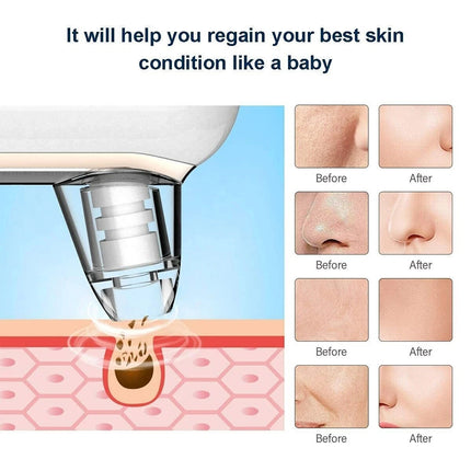Vacuum Blackhead Remover Skin Acne Pore Pimple Extractor Suction Cleaner USB