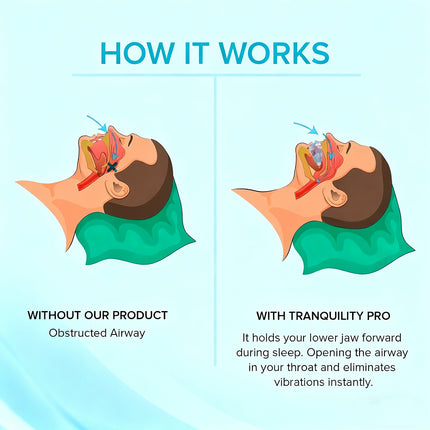 Anti-Snore Mouthpiece & Grinding Guard – Effective Sleep Aid for Snoring & Teeth Clenching