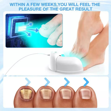 Foldable Onychomycosis Toes Nail Toenails &Fingernail Fungus Polish Curing Light