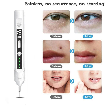 Plasma Beauty Pen for Skin Blemish Freckle & Dark Spot Pigment Correction Beauty Device White