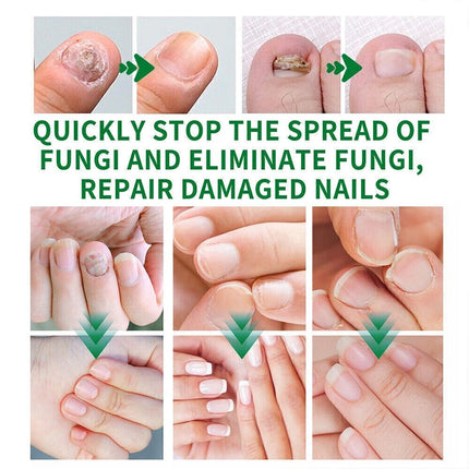 Anti-Fungal Laser Nail Treatments Repair Finger Toe Foot Care Nail Fungus Device