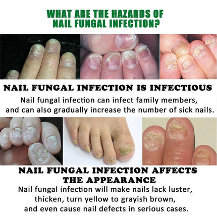 Anti-Fungal Laser Nail Treatments Repair Finger Toe Foot Care Nail Fungus Device