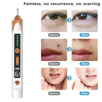 Laser Plasma Pen Skin Tag Mole Wart Freckle Dark Spot Tattoo Removal Machine
