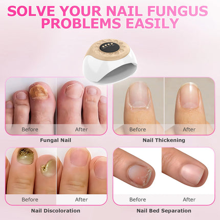 Anti-Fungal Laser Nail Treatments Repair Finger Toe Foot Care Nail Fungus Device