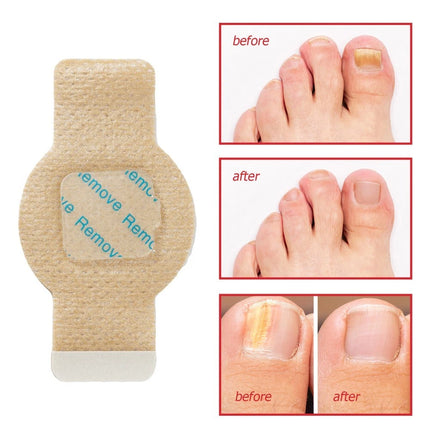 63Pcs Toenail Antiseptic Patch Long Lasting Breathable Fungal Nail Patches