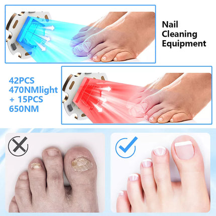 Fungal Nail Laser Treatment Device Highly Effective Kill Toenail Beriberi Fungus