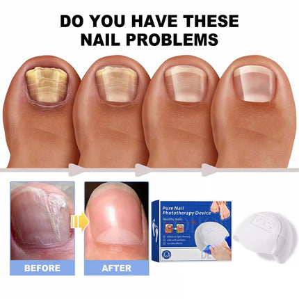 Protable Fungus Laser Therapy Device, Light Therapy Device Fungal-Nail