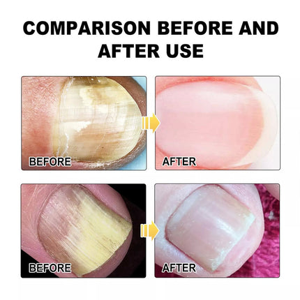 Protable Fungus Laser Therapy Device, Light Therapy Device Fungal-Nail