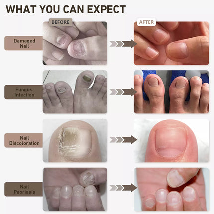 Fungal Nail Laser Treatment Device Highly Effective Kill Toenail Beriberi Fungus