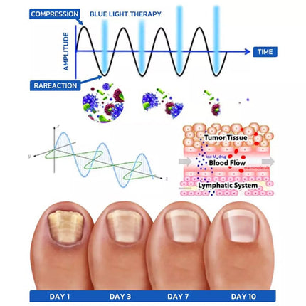 Nail Fungus Removal Treatment Cleaning Laser Therapy Device Toenail Fingernail
