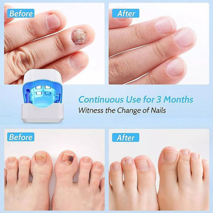 Nail Fungus Removal Treatment Cleaning Laser Therapy Device Toenail Fingernail
