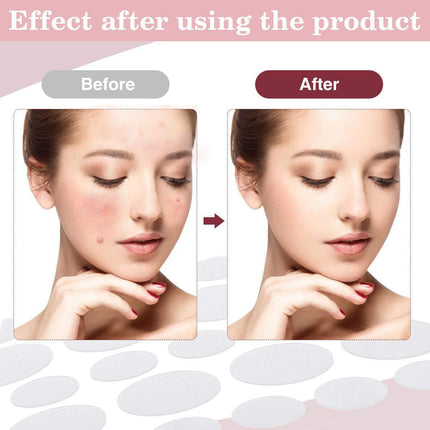 36 Pcs Acne Pimple Patch Splendid&Co.