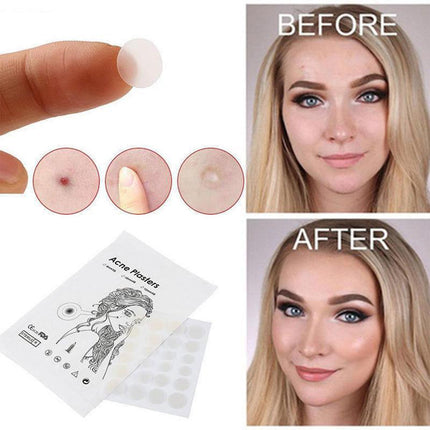 36 Pcs Acne Pimple Patch Splendid&Co.